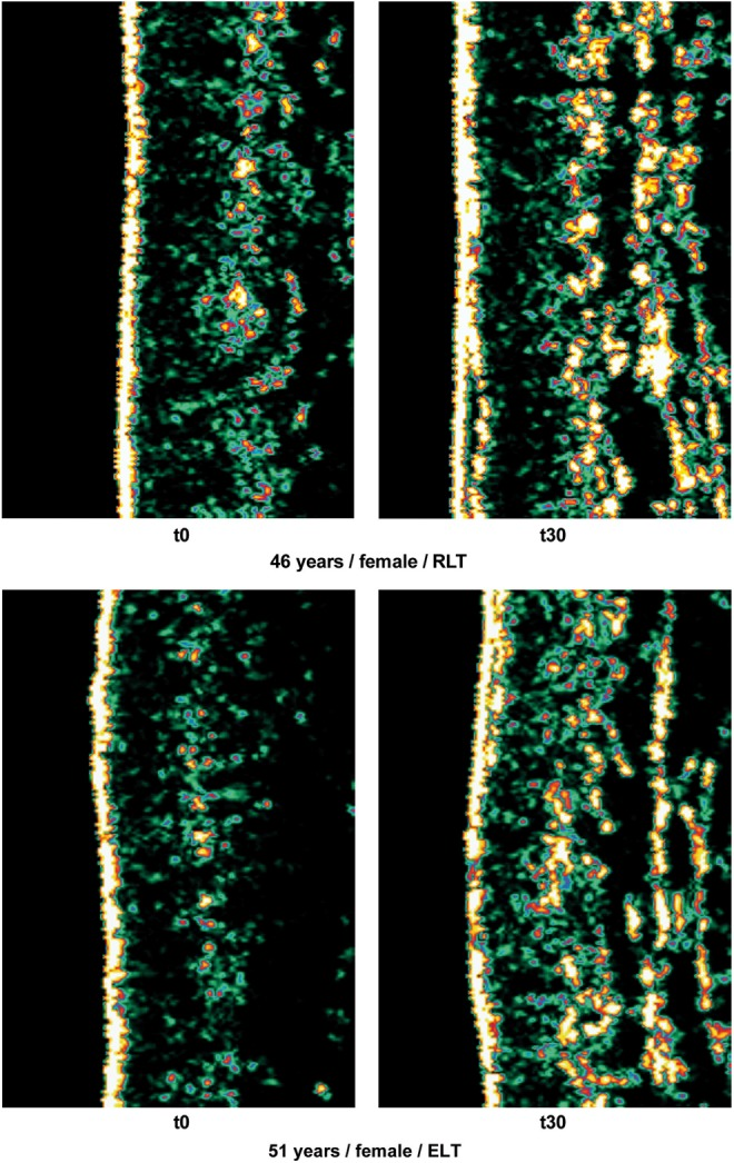 Red Light Therapy Collagen Before After.png