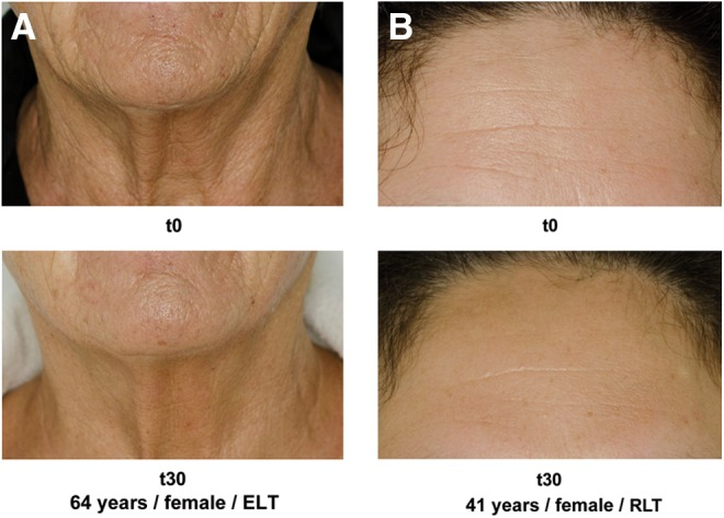 Red Light Therapy Skin Quality Before After.png